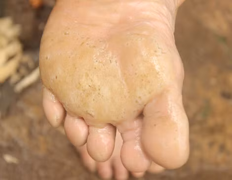 Bàn chân lở loét vì dùng nước bẩn.