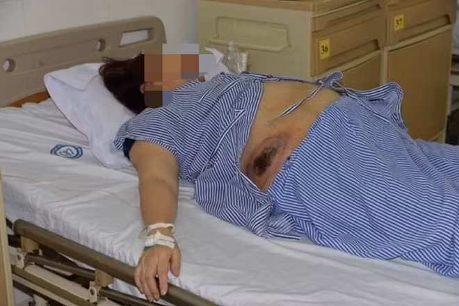 Bệnh nhân Đào Thị Đ bị nhiễm trùng nặng sau khi bôi thuốc trôi nổi