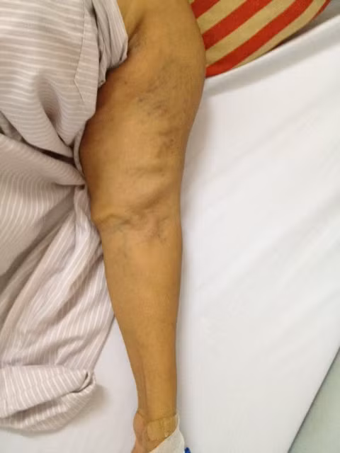 Cánh tay bệnh nhân sau khi được can thiệp đặt stent.