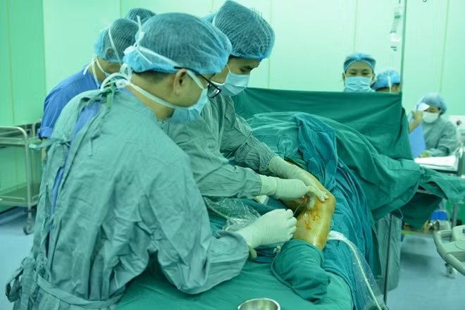 Ứng dụng keo sinh học trong điều trị suy giãn tĩnh mạch nông chi dưới