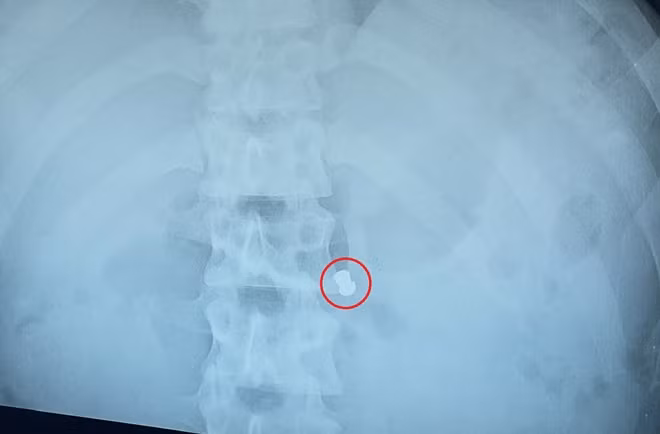 Hình ảnh viên đạn chì súng hơi trên phim X-quang.