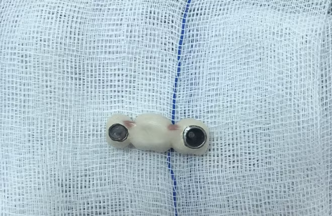 4 chiếc răng giả đã được các BS lấy ra khỏi dạ dày bệnh nhân.