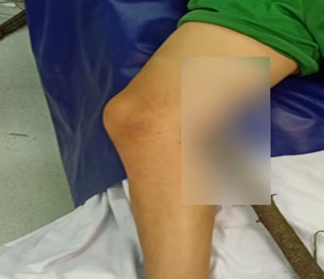 Cành chanh đầy gai đâm xuyên đùi cháu K. từ sau ra trước.