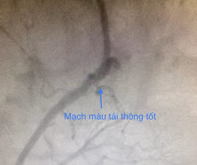 Và sau khi can thiệp thành công.