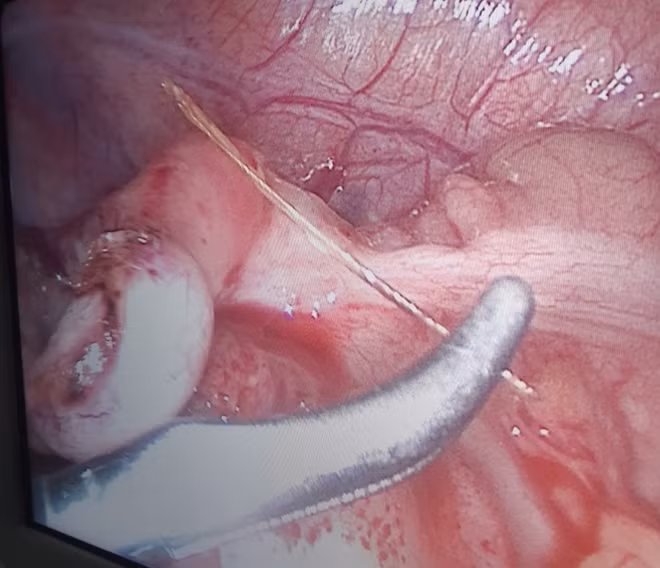 Các BS dùng kẹp lấy xương cá ra khỏi người bệnh nhi.