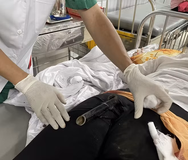 Bệnh nhân nhập viện trong tình trạng bị chân chống xe máy đâm vào mông.