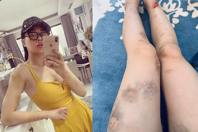 Trước đó, hình ảnh được nữ diễn viên đình đám phía Bắc đăng tải trên mạng xã hội về những vết thương chằng chịt sau khi tham gia "Mỹ nhân hành động" nhận được sự quan tâm đặc biệt từ phía cư dân mạng.