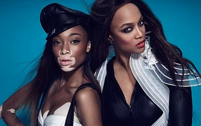 Có thể nói bước đệm lớn nhất dẫn đến thành công như hiện nay của Winnie Harlow đó là được siêu mẫu Tyra Banks, người sáng lập và host của chương trình American’s Next Top Model (ANTM) phát hiện và mời cô casting cho chương trình mùa thứ 21 vào năm 2014.