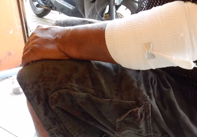 Cánh tay ông Điệp bị Bảo dùng hung khí chém