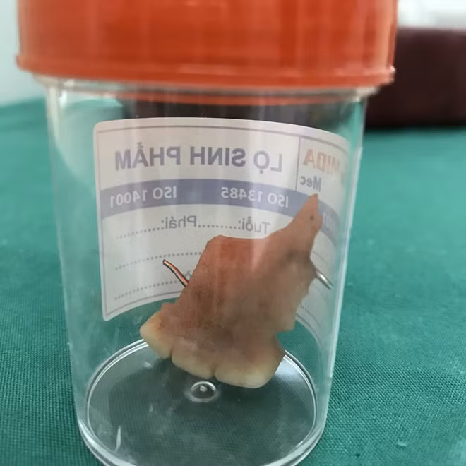Dị vật răng gỉa với mấu nhọn đã được lấy ra thành công.