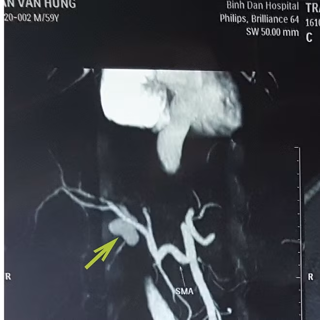Túi giả phình trước khi được can thiệp qua hình ảnh chụp CT-Scaner.