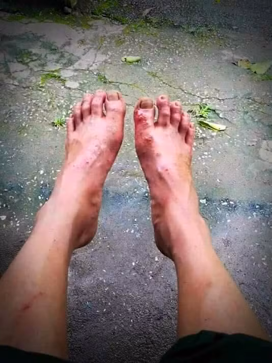 Đôi chân phổng rộp của một chiến sĩ sau những ngày hành quân liên tục để vận chuyển đường ống dẫn nước và các thiết bị cứu hộ vào bên trong hang. Ảnh: Facebook