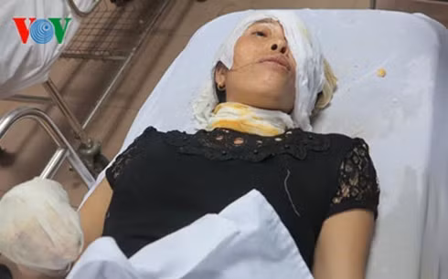 Chị Nguyễn Thị Vân (44 tuổi) - một công nhân bị bỏng nặng ở vùng mặt, tay, chân bàng hoàng nhớ lại giây phút lò hơi phát nổ kinh hoàng.