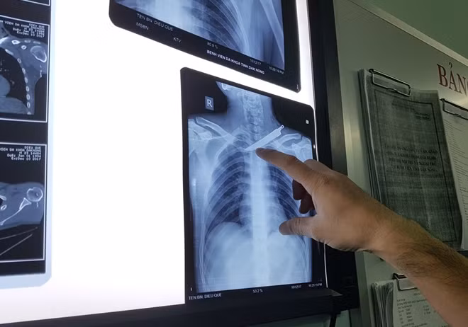 Hình ảnh con dao cắm vào lồng ngực, gây thủng phổi bệnh nhân