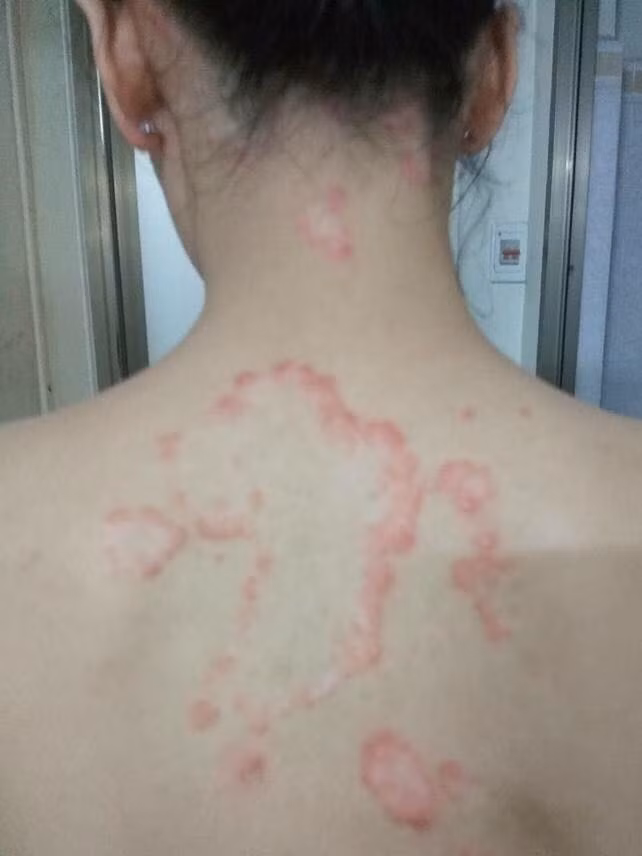 Bệnh nhân bị vẩy nến
