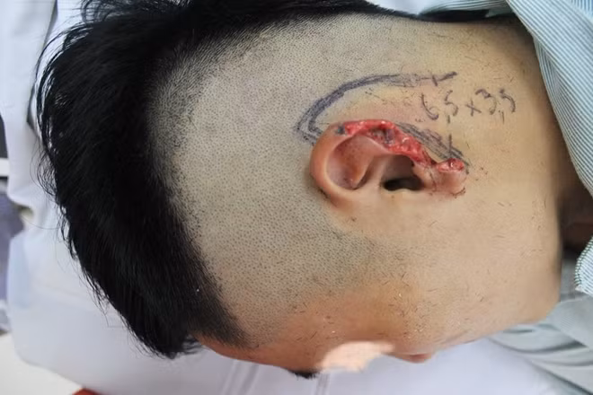 Bệnh nhân M bị cắn đứt tai trong bữa nhậu