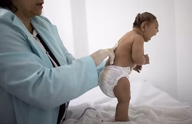 Bệnh đầu nhỏ ở trẻ do virus Zika đang khiến thế giới lo âu