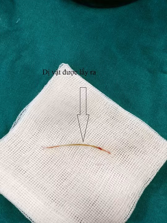 Chiếc xương cá gây thủng ruột và áp xe trong ổ bụng bệnh nhân