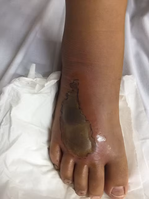 Bệnh nhi bị rắn cắn đang điều trị tại BV Bạch Mai