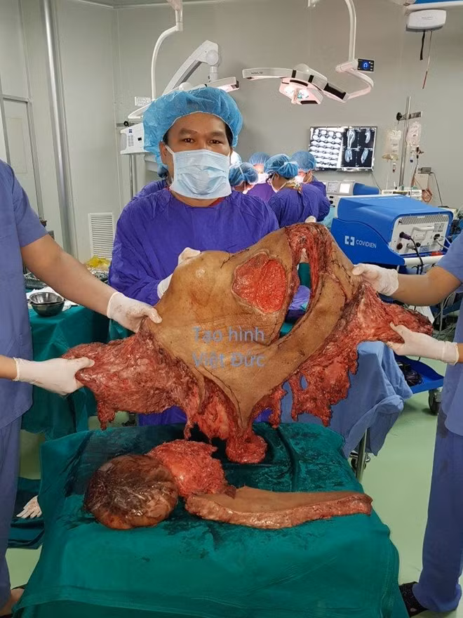 Khối u khổng lồ được cắt bỏ nặng 23kg