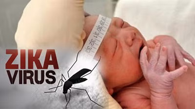 Chứng đầu nhỏ ở trẻ sơ sinh liên quan đến virus Zika