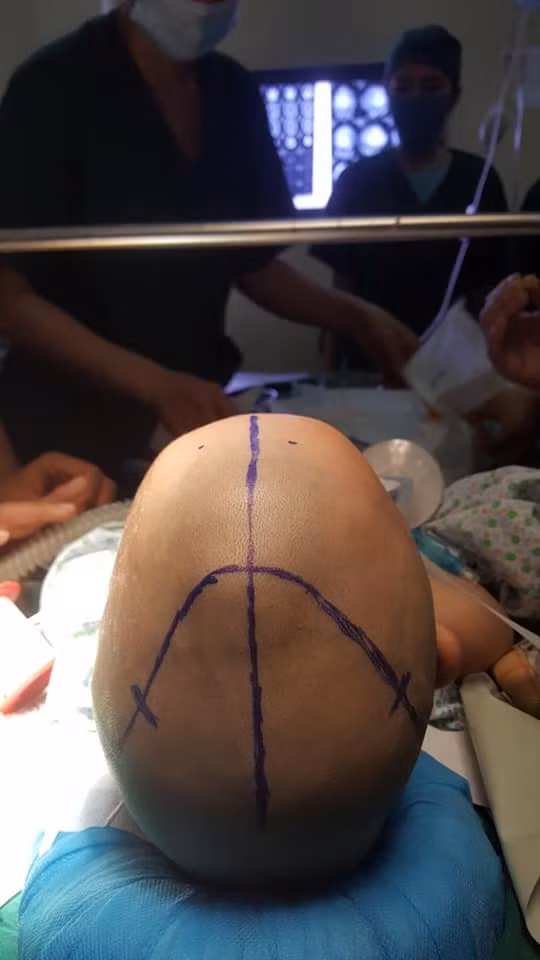 Hình ảnh hộp sọ cháu bé bị biến dạng trước khi mổ