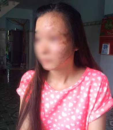 Tương lai của nữ sinh viên H. sẽ về đâu nếu như H. không vượt qua được cú sốc khi rời bệnh viện với khuôn mặt biến dạng?