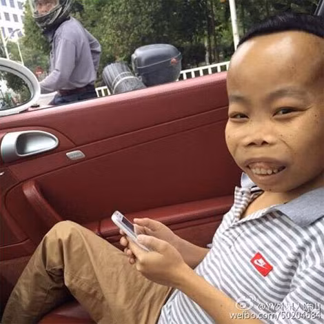 "Hotboy trên mạng" Trần Sơn với gương mặt điển hình của bệnh nhân thalassemia.