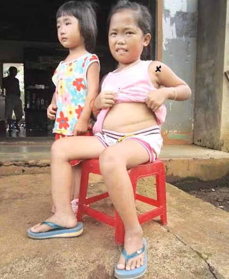 Cháu Nguyễn Ngọc Quỳnh Như (x) đang rất cần sự giúp đỡ của cộng đồng.