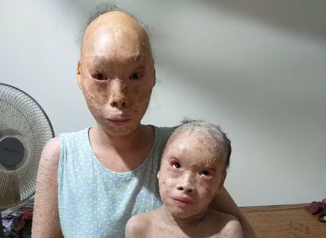 Thảo giờ đã bớt tự ti với hình hài không giống ai của mình.