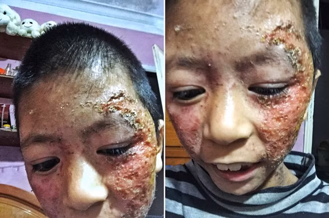 Khuôn mặt lở loét của bé Phương hơn 1 năm trước.