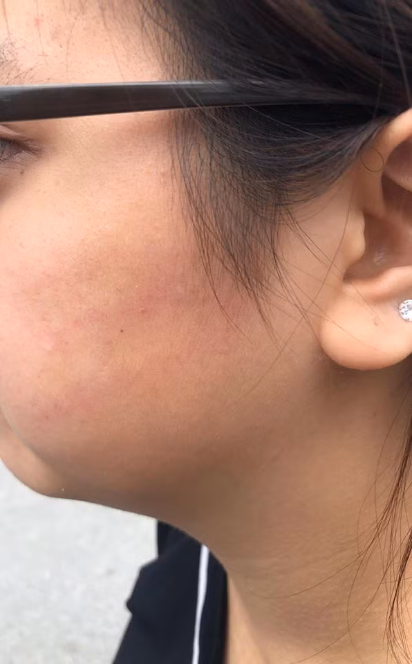 Vết hằn trên má sau khi Giang bị tát.