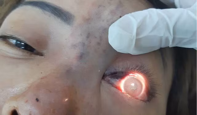 Truyền chất làm đầy filler để nâng mũi gây biến chứng mù mắt.