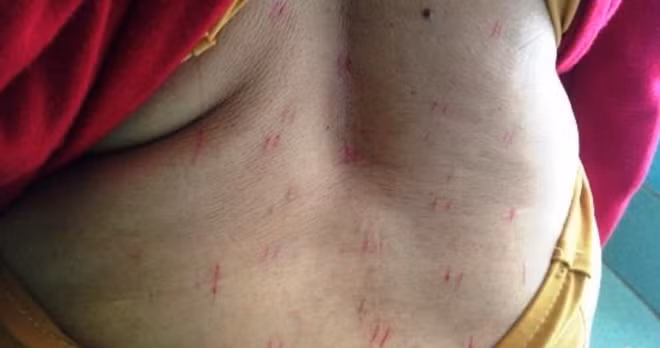 Trò chữa bệnh bằng rạch dao lam trên người bệnh nhân.