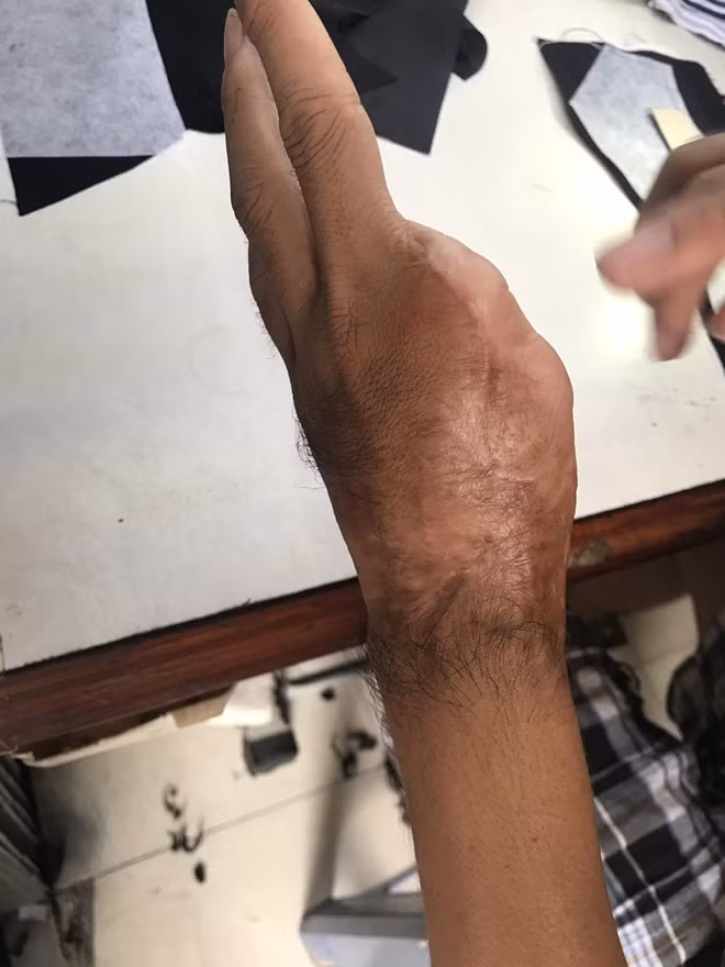 Đôi bàn tay cũng bị cắt đứt hai ngón.