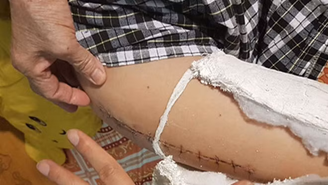 Cháu Trần Chí Kiên, nạn nhân bị gãy xương đùi tại trường Tiểu học Nam Trung Yên, Cầu Giấy (Hà Nội)