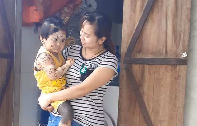 Chị Son đang dỗ dành cô con gái bị mắc bệnh u sắc tố toàn thân của mình.