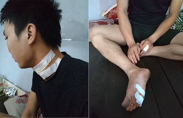 Vết thương của anh Thành.