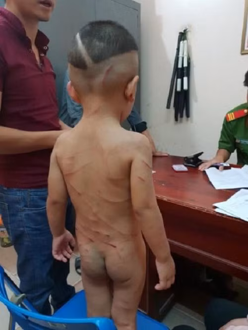 Cháu bé bị Võ Huyền Anh bạo hành gây thương tích toàn cơ thể.