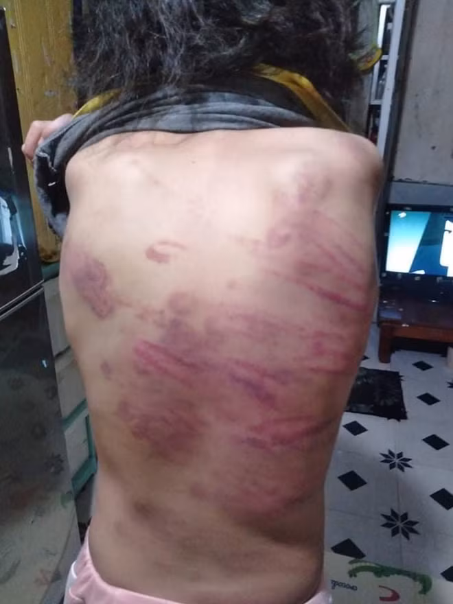 Những vết bầm tím chằng chịt trên lưng cháu B.