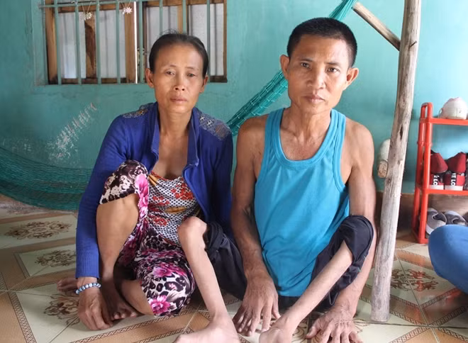 Đôi chân ông Trần Văn Tam teo tóp do bại liệt từ nhỏ.