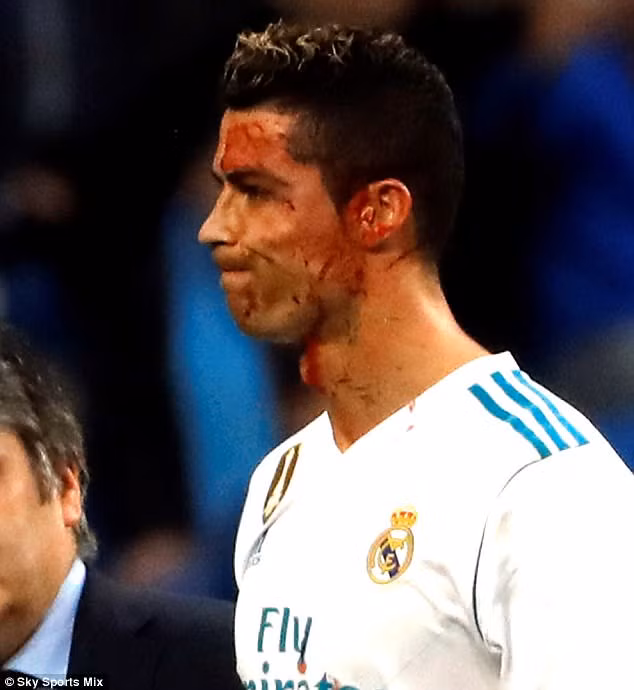 Khuôn mặt đầm đìa máu của Ronaldo. Ảnh: Sky.