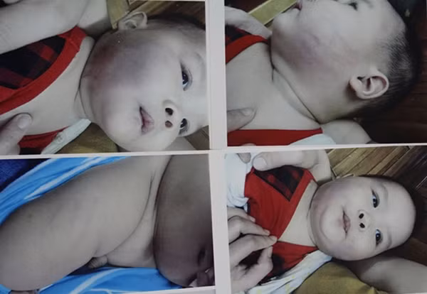 Bé Nguyễn Hồng Phương Anh tại bệnh viện Sản nhi Đà Nẵng và những vết bầm tím.