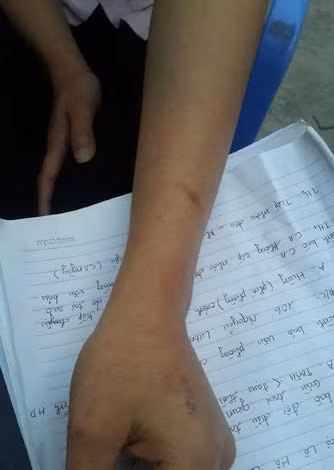 Vết thương trên cánh tay, chị Lan nói rằng do bị D. đánh.
