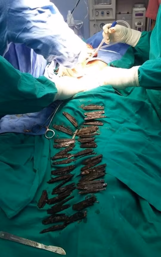 ...và họ lấy 40 con dao ra khỏi bụng bệnh nhân Jarnail ...và họ lấy 40 con dao ra khỏi bụng bệnh nhân Jarnail