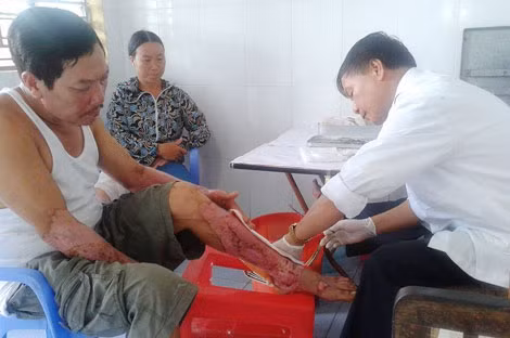 Chăm sóc bệnh nhân bỏng ở chân.
