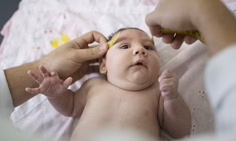 Thai phụ nhiễm Zika không nên quá lo lắng vì tỉ lệ bị dị tật đầu nhỏ chỉ chiếm rất thấp. Ảnh: minh họa.