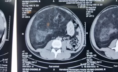Hình chụp CT cho thấy các khối bướu lớn chiếm trọn ổ bụng và chèn ép các cơ quan nội tạng khác.