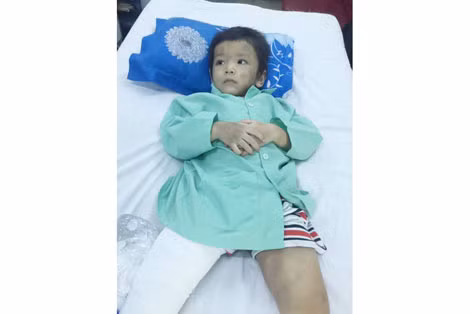 Cháu Thiện bị đánh gãy chân và thân thể bị bầm tím nhiều chỗ.