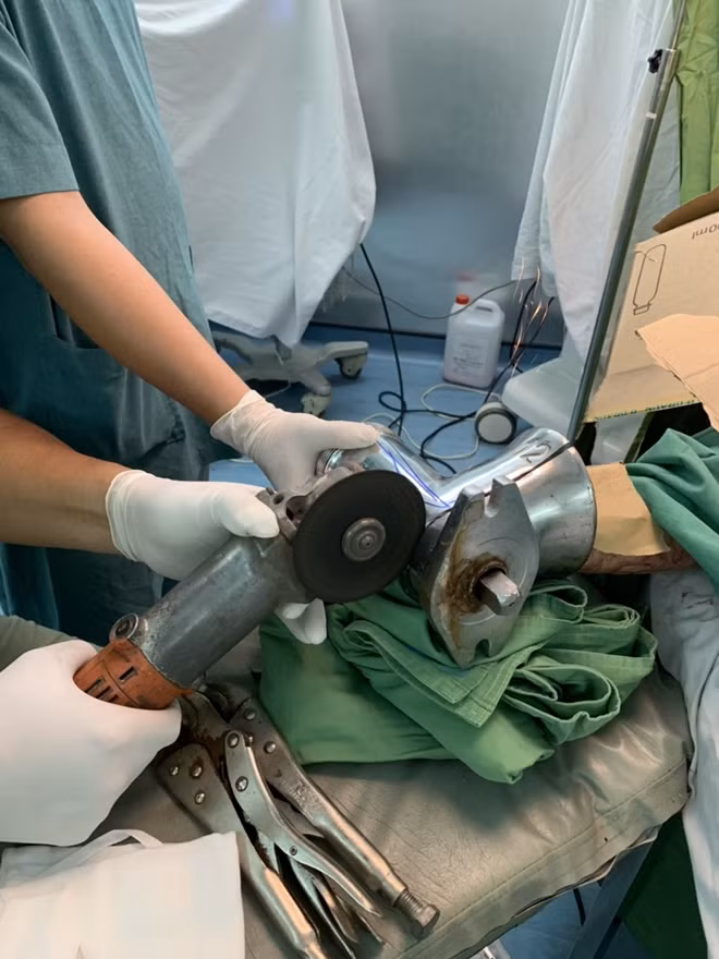 Ê kíp phải cưa từng phần máy xay thịt để làm lộ bàn tay phải của bệnh nhân, xử trí vết thương